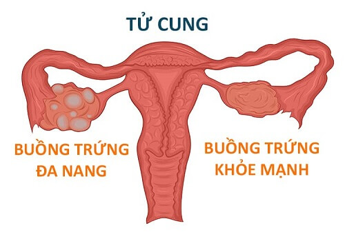 Buồng trứng đa nang 